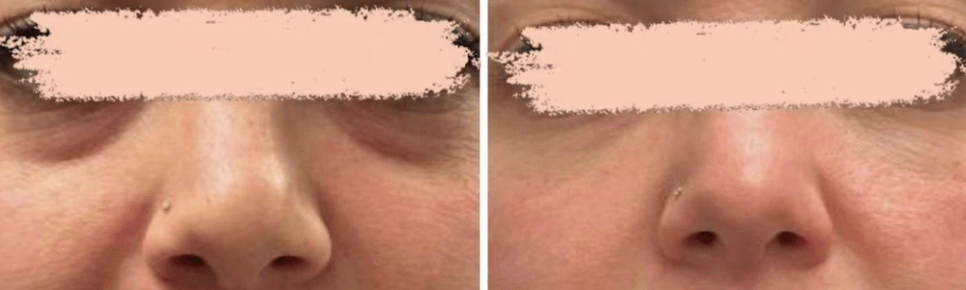 Full face before and after