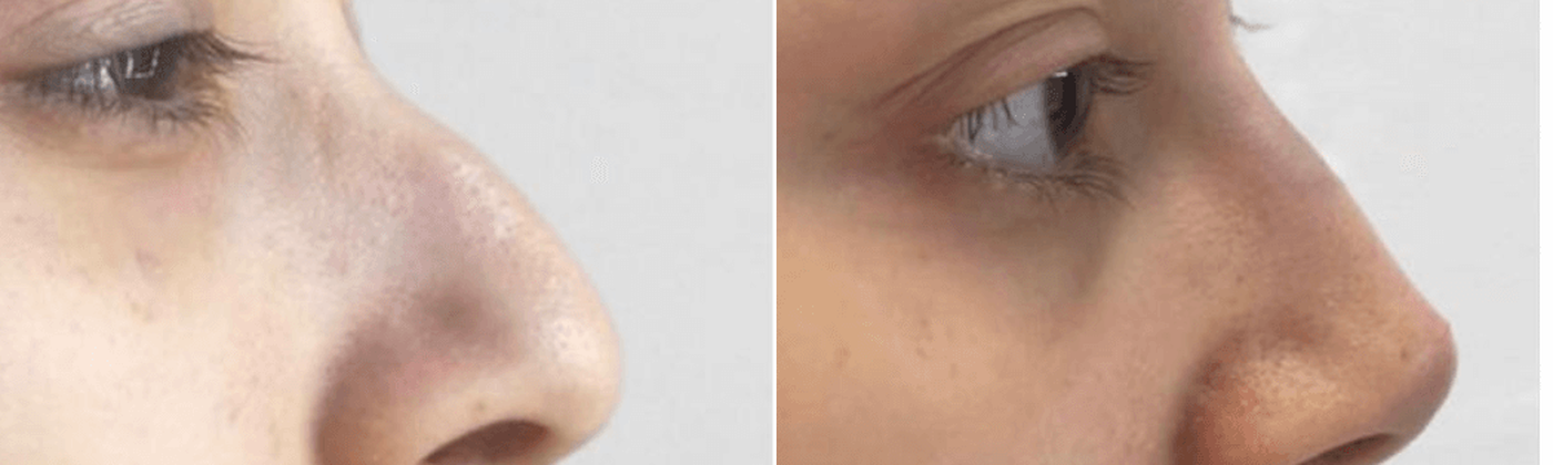 Jawline contouring before and after