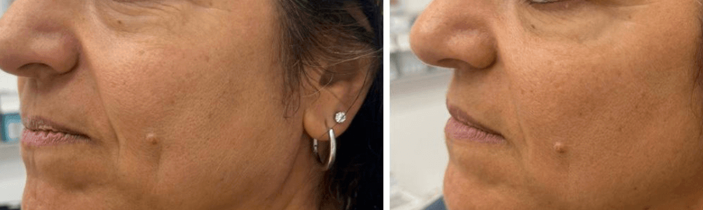 Eye and cheek area before and after