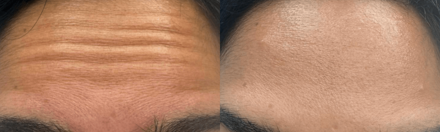 Forehead lines before and after