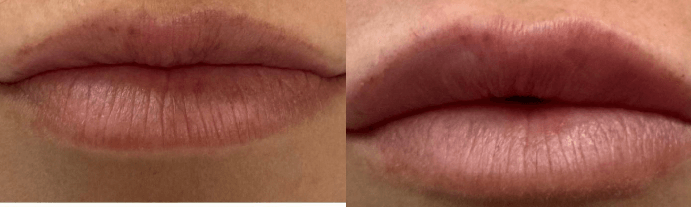 Lip filler before and after