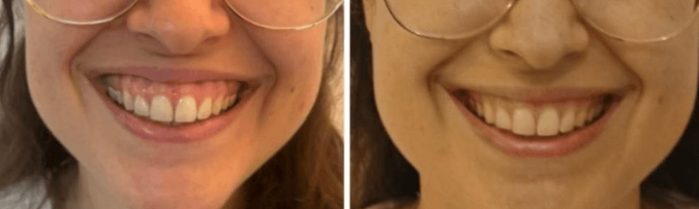 Skin rejuvenation before and after