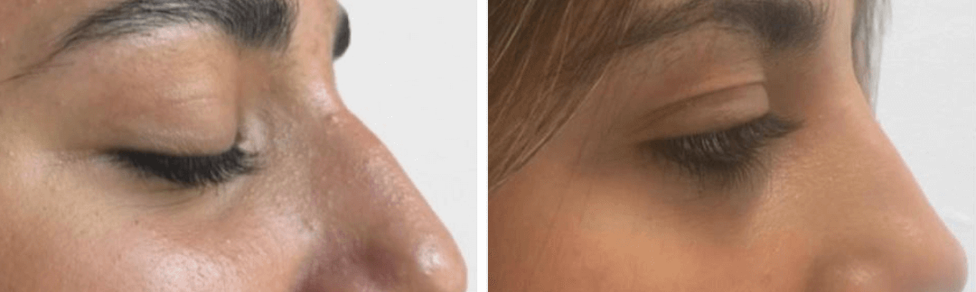 Dermal filler before and after